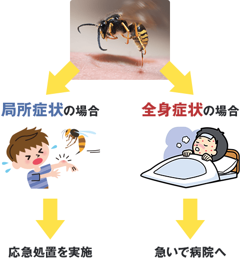 1分で理解できる ハチに刺された時の応急処置